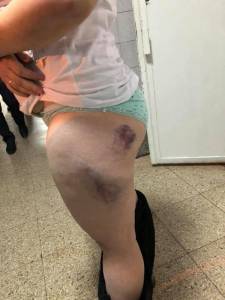 У женщины, избитой в метро Киева полицейскими, может случится выкидыш    